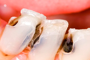 Что нужно знать про кариес зубов.