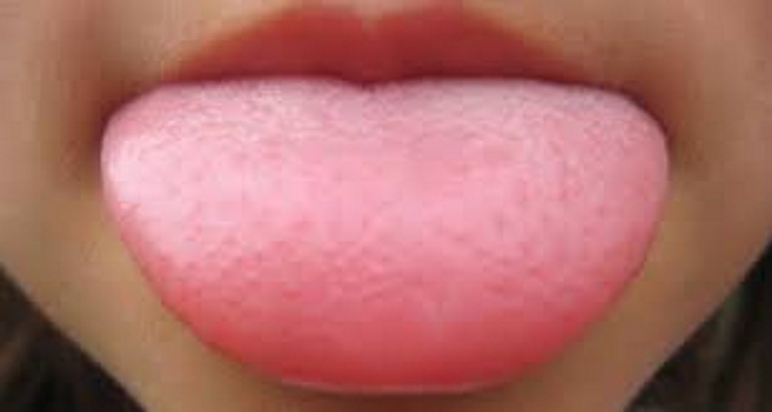 Свесив набок длинный розовый язык. Мелкая красная сыпь на языке.